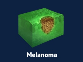 melanoma